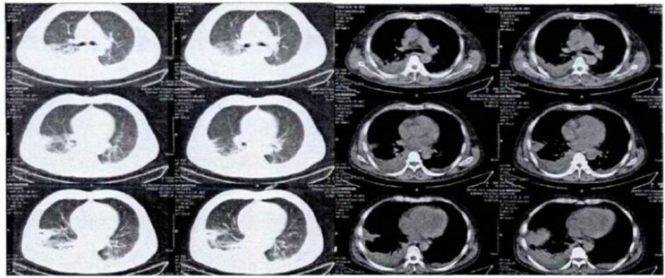 CT-scanning of the infected lungs of one miner.